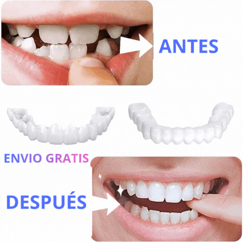 CARILLAS DENTALES CAMBIA TU SONRISA EN MINUTOS.